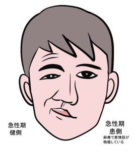 急性期顔面麻痺