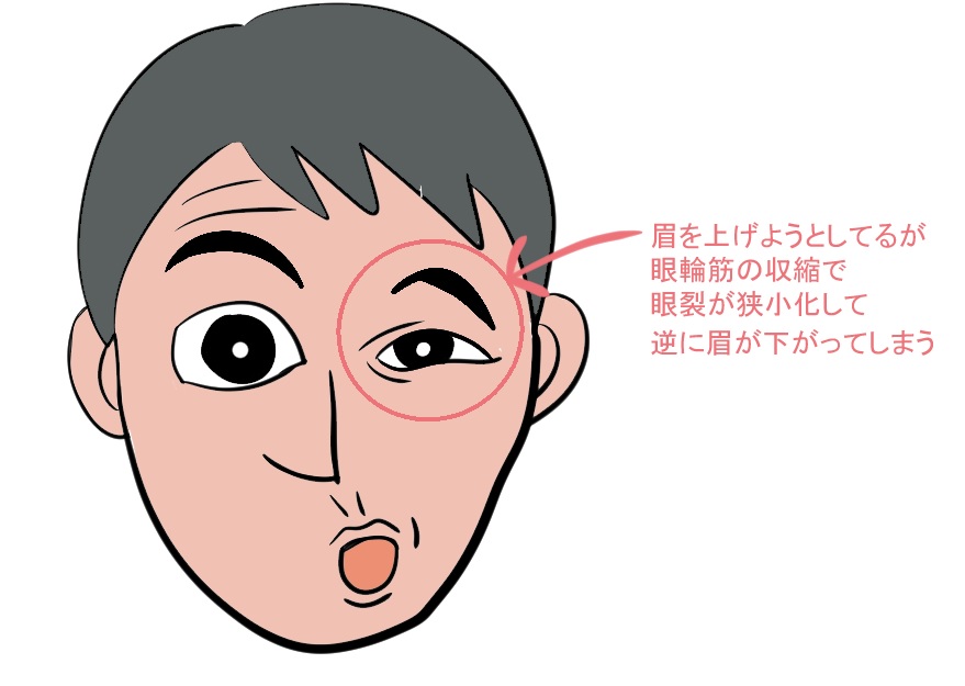顔面神経麻痺の拘縮